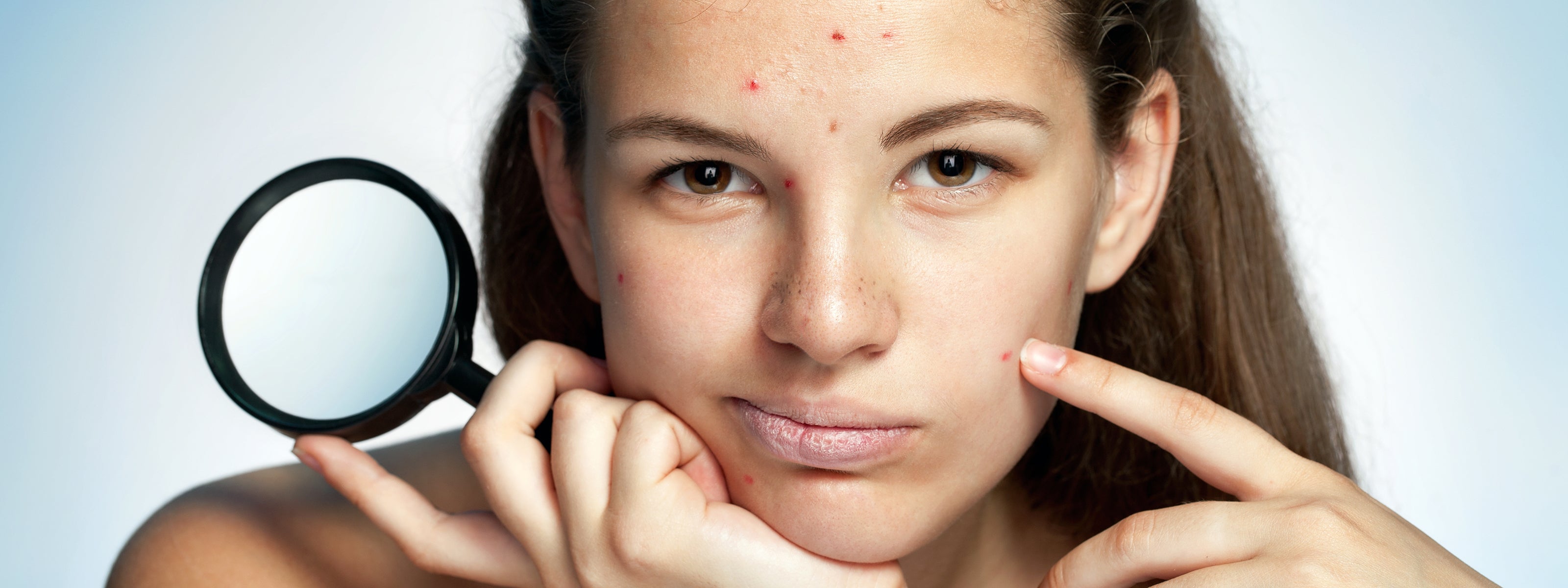 Transform Your Acne-Prone Skin: A Guide to Clearer, Healthier Complexion